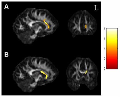 Assessment of Disrupted Brain Structural Connectome in Depressive Patients With Suicidal Ideation Using Generalized Q-Sampling MRI